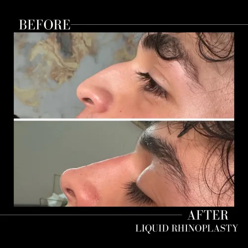 Rhinoplasty before and after - W Aesthetics in Austin, TX