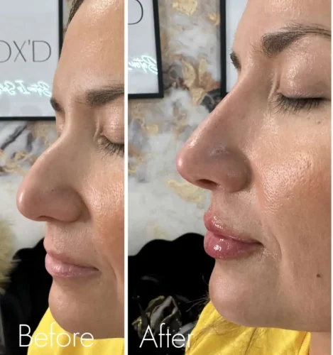 Rhinoplasty before and after - W Aesthetics in Austin, TX