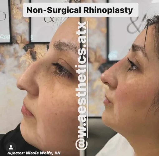 Rhinoplasty before and after - W Aesthetics in Austin, TX