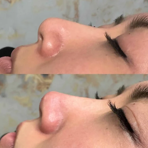Rhinoplasty before and after - W Aesthetics in Austin, TX