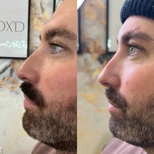 Rhinoplasty before and after - W Aesthetics in Austin, TX