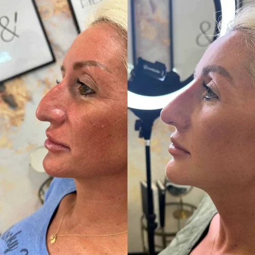 Rhinoplasty before and after - W Aesthetics in Austin, TX