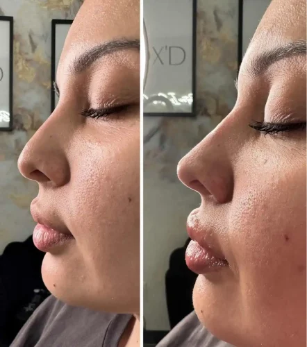 Rhinoplasty before and after - W Aesthetics in Austin, TX