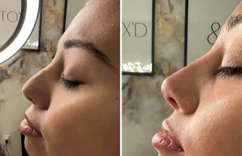 Rhinoplasty before and after - W Aesthetics in Austin, TX