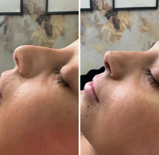 Rhinoplasty before and after - W Aesthetics in Austin, TX
