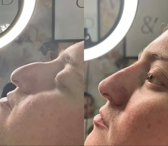 Rhinoplasty before and after - W Aesthetics in Austin, TX