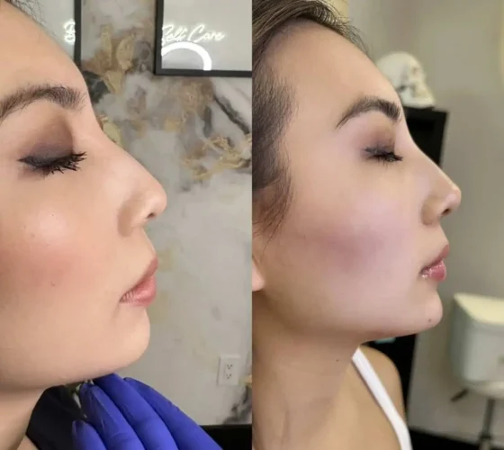 Rhinoplasty before and after - W Aesthetics in Austin, TX