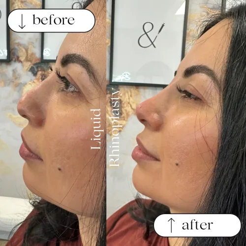 Rhinoplasty before and after - W Aesthetics in Austin, TX