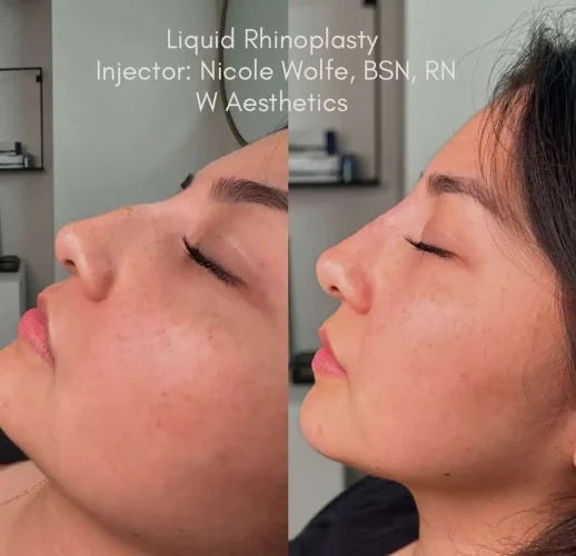 Rhinoplasty before and after - W Aesthetics in Austin, TX
