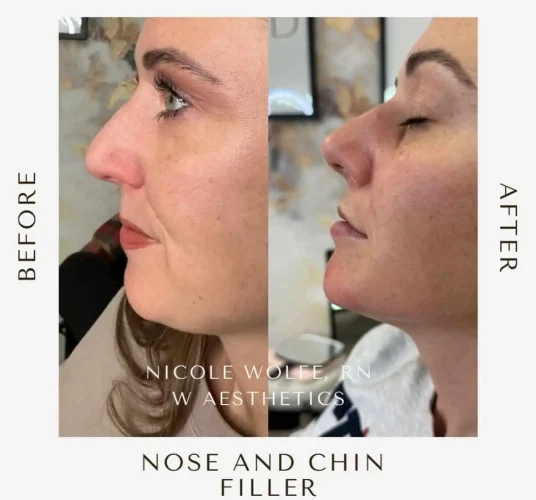 Rhinoplasty before and after - W Aesthetics in Austin, TX
