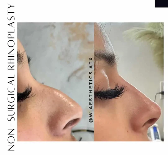 Rhinoplasty before and after - W Aesthetics in Austin, TX