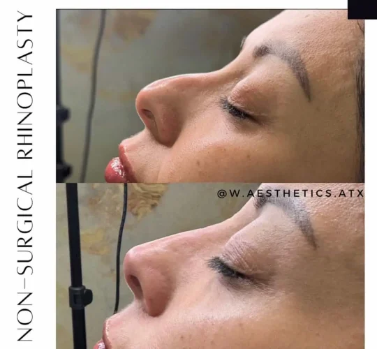 Rhinoplasty before and after - W Aesthetics in Austin, TX