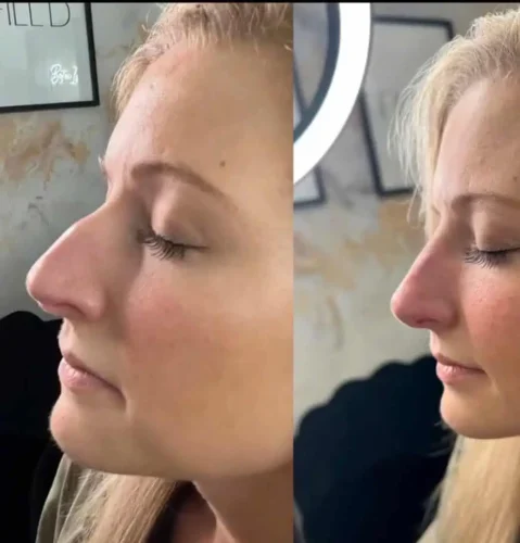 Rhinoplasty before and after - W Aesthetics in Austin, TX