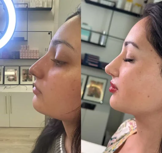 Rhinoplasty before and after - W Aesthetics in Austin, TX