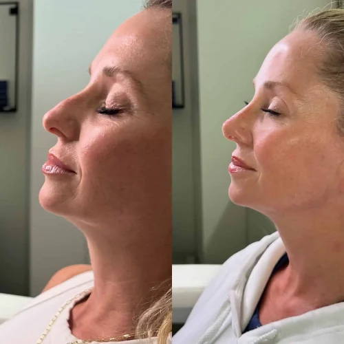 Rhinoplasty before and after - W Aesthetics in Austin, TX