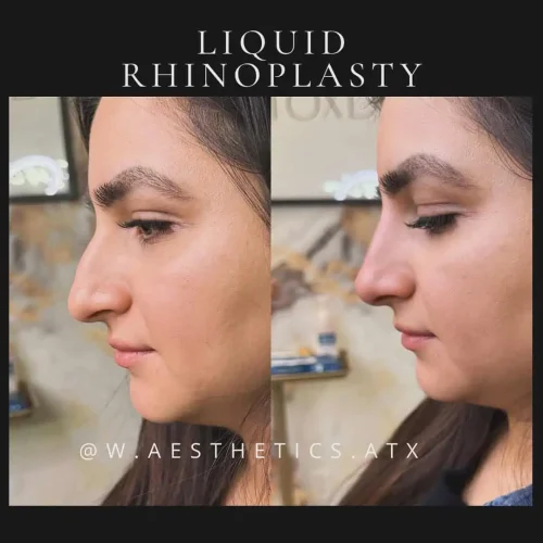 Rhinoplasty before and after - W Aesthetics in Austin, TX