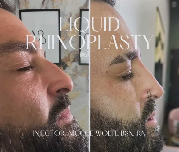 Rhinoplasty before and after - W Aesthetics in Austin, TX