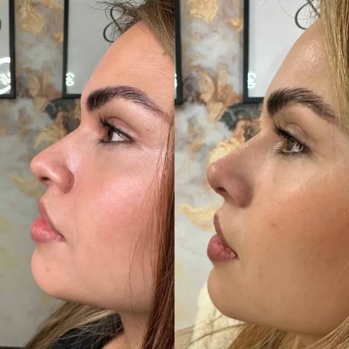 Rhinoplasty before and after - W Aesthetics in Austin, TX