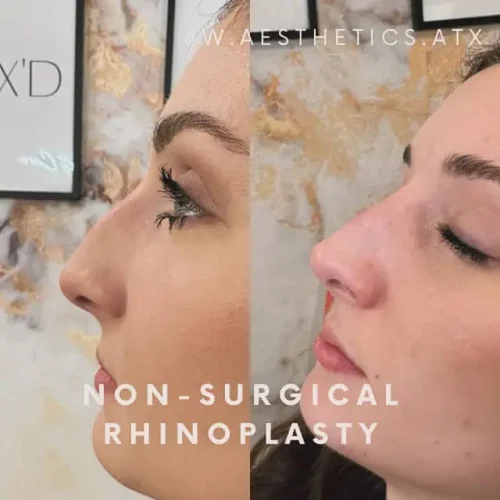 Rhinoplasty before and after - W Aesthetics in Austin, TX