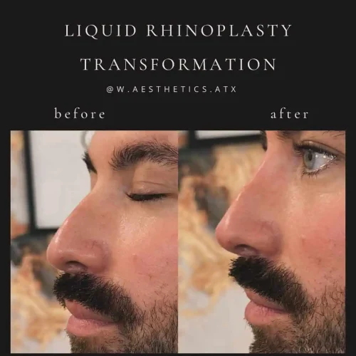 Rhinoplasty before and after - W Aesthetics in Austin, TX