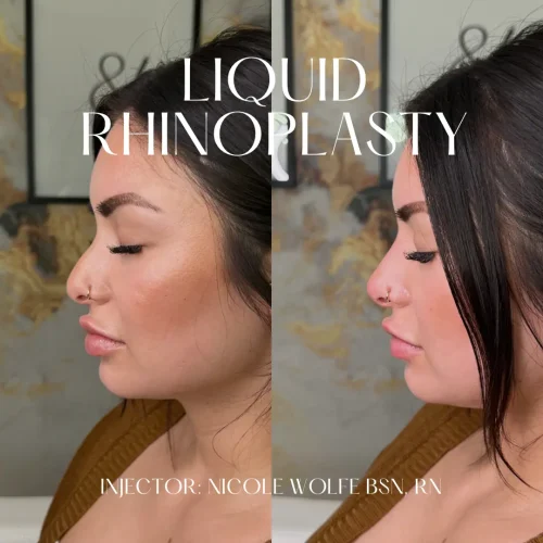 Rhinoplasty before and after - W Aesthetics in Austin, TX