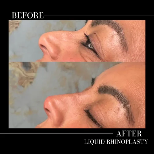 Rhinoplasty before and after - W Aesthetics in Austin, TX