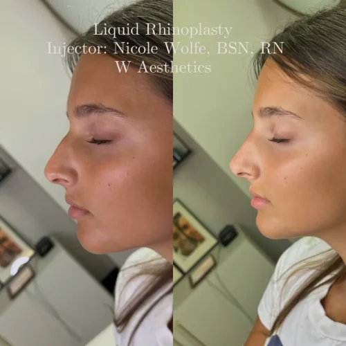 Rhinoplasty before and after - W Aesthetics in Austin, TX