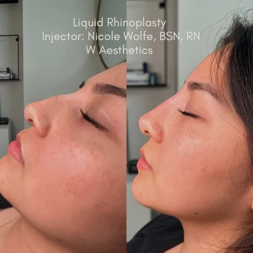 Rhinoplasty before and after - W Aesthetics in Austin, TX