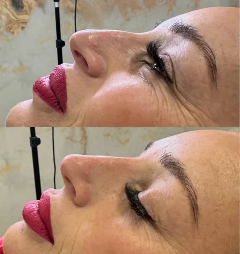 Rhinoplasty before and after - W Aesthetics in Austin, TX