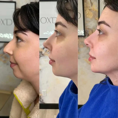 Rhinoplasty before and after - W Aesthetics in Austin, TX