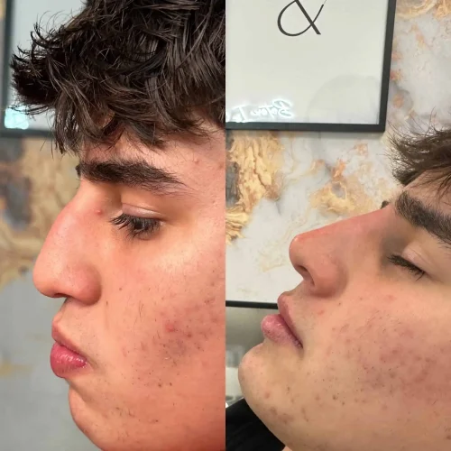 Rhinoplasty before and after - W Aesthetics in Austin, TX