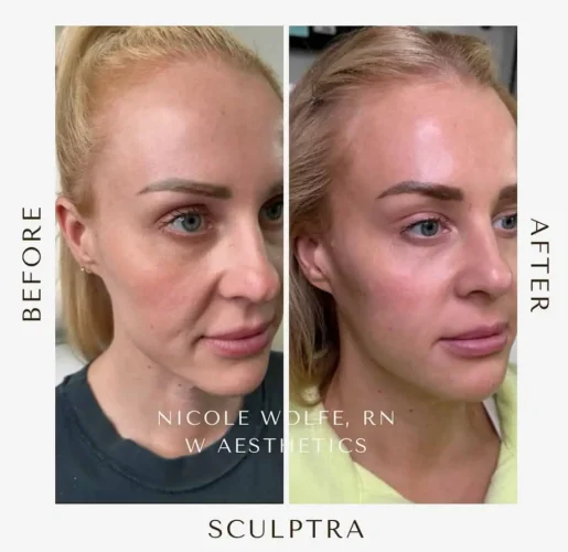 Sculptra Before and After Results at W Aesthetics in Austin, TX