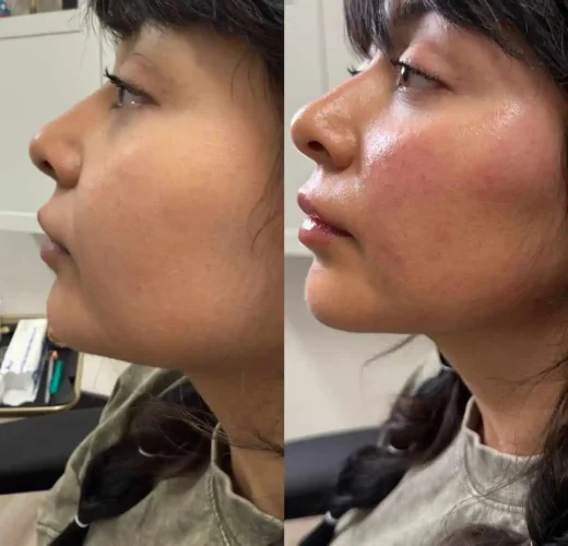 Dermal Fillers at W Aesthetics in Austin, TX