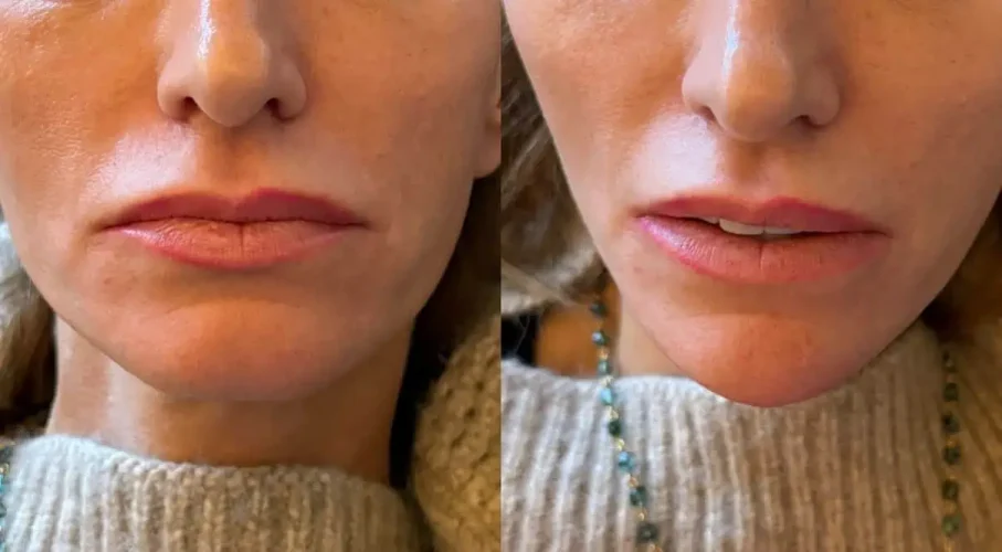 Dermal Fillers at W Aesthetics in Austin, TX