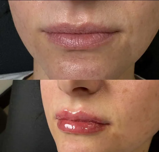 Lip Fillers at W Aesthetics in Austin, TX