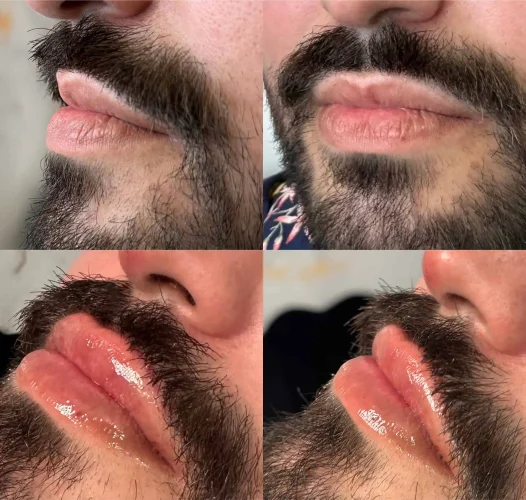 Dermal Fillers - before and after - W Aesthetics in Austin, TX
