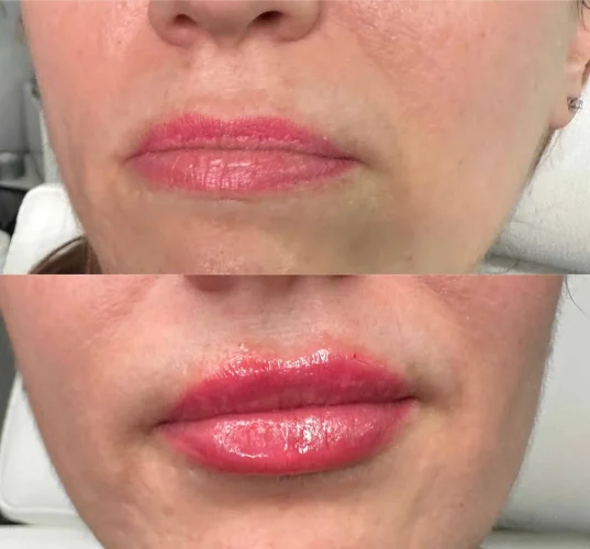 Dermal Fillers - before and after - W Aesthetics in Austin, TX