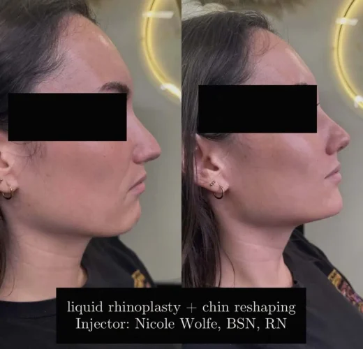 Dermal Fillers - before and after - W Aesthetics in Austin, TX