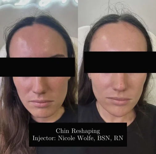 Dermal Fillers - before and after - W Aesthetics in Austin, TX