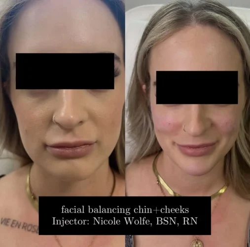 Dermal Fillers - before and after - W Aesthetics in Austin, TX