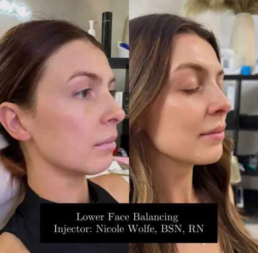 Dermal Fillers - before and after - W Aesthetics in Austin, TX