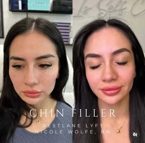 Dermal Fillers - before and after - W Aesthetics in Austin, TX