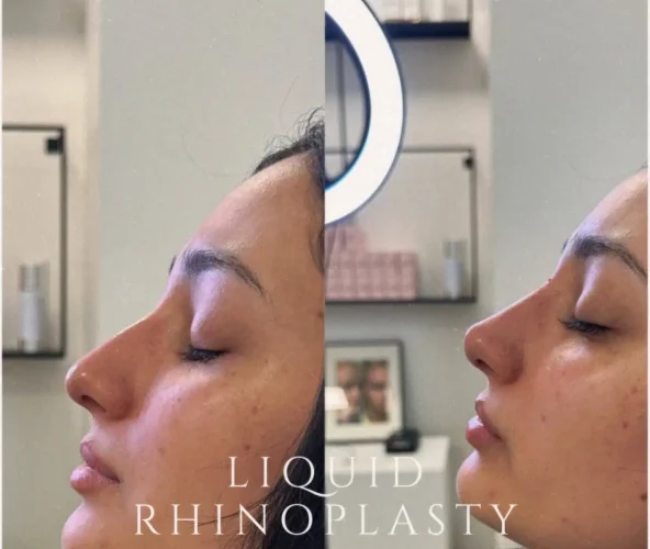 Dermal Fillers - before and after - W Aesthetics in Austin, TX