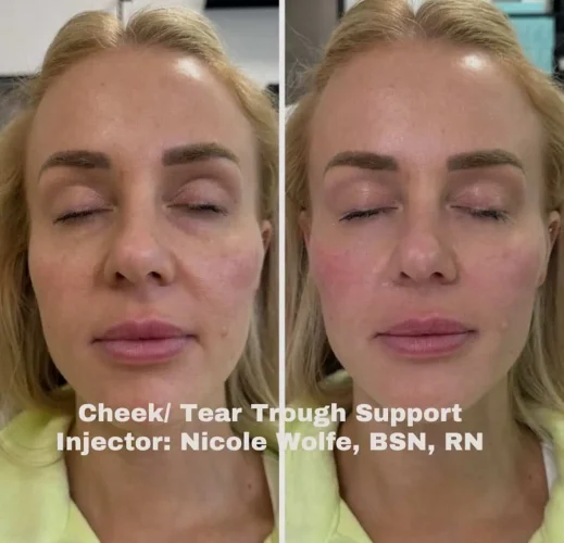 Dermal Fillers - before and after - W Aesthetics in Austin, TX