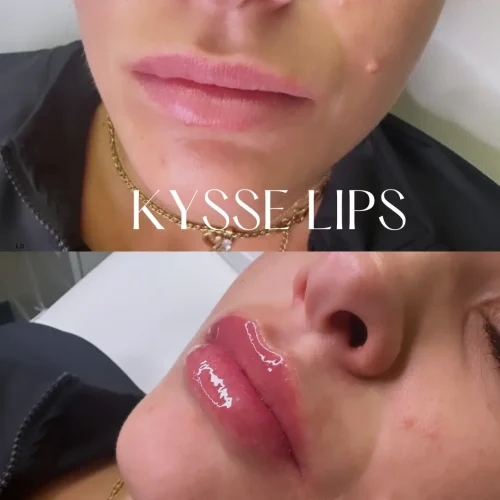 Dermal Fillers - before and after - W Aesthetics in Austin, TX