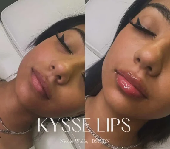 Dermal Fillers - before and after - W Aesthetics in Austin, TX