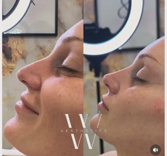 Dermal Fillers - before and after - W Aesthetics in Austin, TX