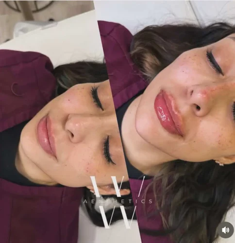Dermal Fillers - before and after - W Aesthetics in Austin, TX