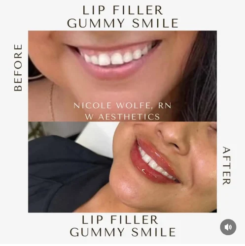 Dermal Fillers - before and after - W Aesthetics in Austin, TX