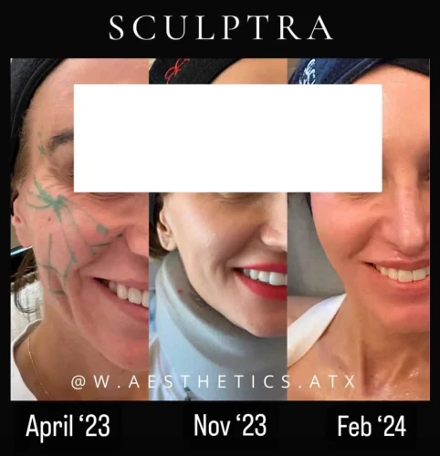 Dermal Fillers - before and after - W Aesthetics in Austin, TX